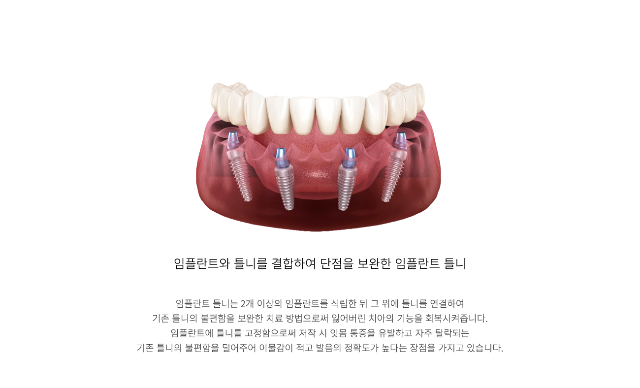 ���ö�ƮƲ��